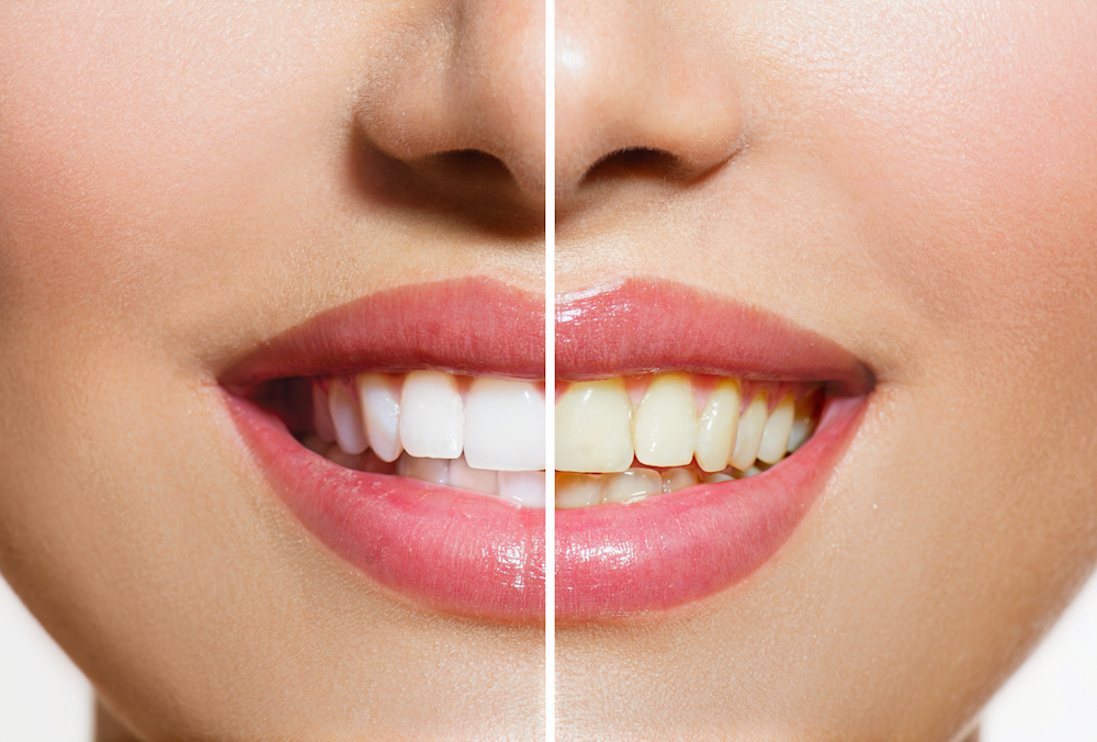 Stained Teeth | Dentist in Norfolk